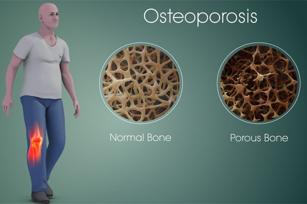 Anti Osteoporosis